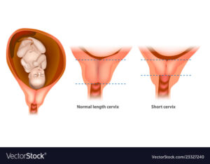 cuello uterino corto