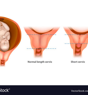 cuello uterino corto