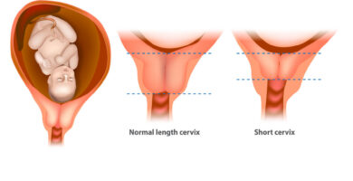 cuello uterino corto