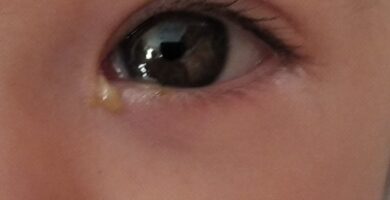 legaña recién nacido