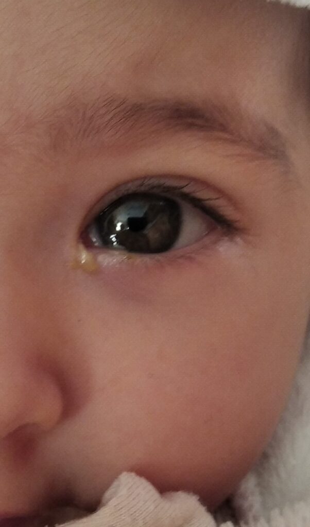 Recién nacido con legañas